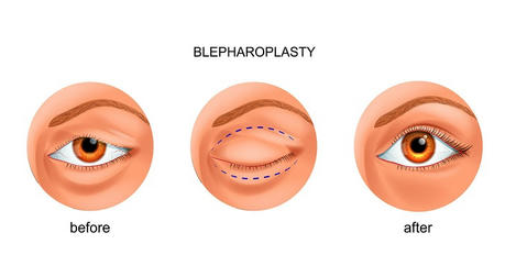 Blepharoplasty: Painless and Quick Beauty
